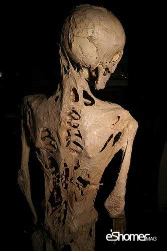 سندرم مرد سنگی بیماری نادری که انسان را به استخوان تبدیل میکند