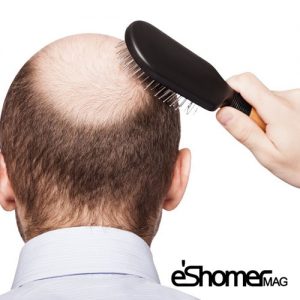 علت ریزش موهای سر و درمان آن به روش خانگی 1