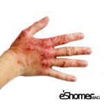 بیماری اگزما Eczema یا درماتیت دست پیشگیری و درمان آن