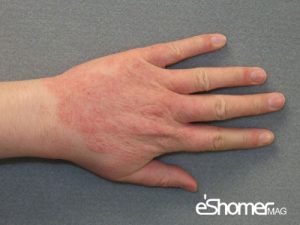 مجله خبری ایشومر -اگزما-Eczema-یا-درماتیت-دست-پیشگیری-و-درمان-آن-2-مجله-خبری-ایشومر-300x225 بیماری اگزما Eczema یا درماتیت دست پیشگیری و درمان آن سبک زندگی سلامت و پزشکی  وازلین کرم مرطوب کننده درمان پیشگیری پوست پزشکی بیماری اگزما  