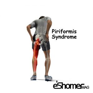 بیماری سندروم پیریفورمیس piriformis syndrome و علائم بیماری