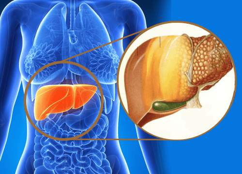 بیماری کبد چرب Fatty liver انواع،دلایل ،علام و پیشگیری